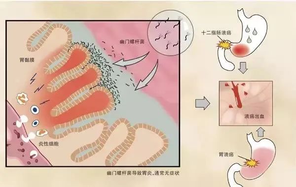 胃痛别不当回事，顾卫能可以调理胃病