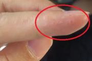 手指上有了这种东西，说明你体内毒素可能堆积如山，不妨对照一下