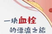 一块“血栓”的危险漂流之旅