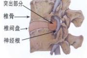 腰间盘突出不是病，其根源不在于骨头，而在于筋