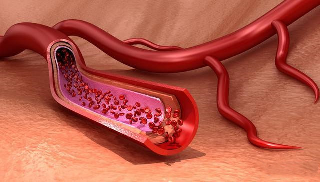 软化血管是真的吗？