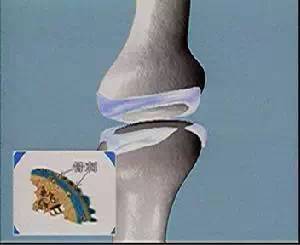 腰椎间盘突出的根，不在于骨头，而在于筋