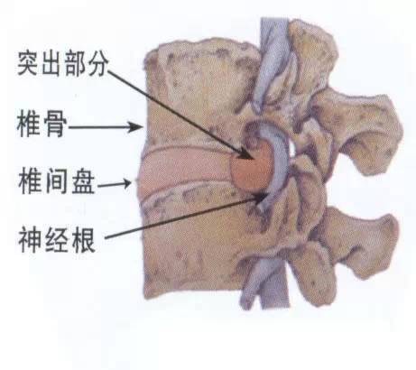 腰椎间盘突出的根，不在于骨头，而在于筋
